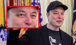 Sağ gözü neden mor? Elon Musk sebebini açıkladı