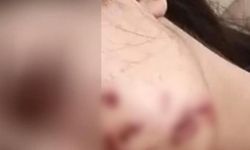 Yüzüne maytap isabet eden genç kız yaralandı