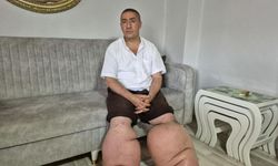 15 yıldır fil hastalığıyla mücadele ediyor