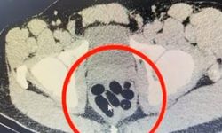 Kayseri'de uyuşturucu operasyonu: Midesinden çıkan şoke etti