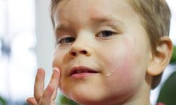 Bebeklerde Egzama: Doğru Tedavi ve Alerji Uzmanı Kontrolü Önemli