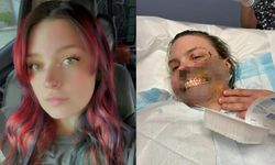 Epilepsi Nöbeti Geçiren Kadına Köpeği Saldırdı: Yüzünde Ağır Yaralar Oluştu