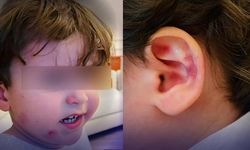 Gemlik'te Kreşte Darp İddiası: 2,5 Yaşındaki Çocuk Zarara Uğradı