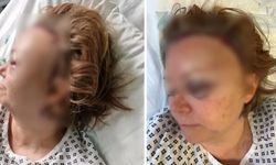 İngiltere'de İş Toplantısında Fenalaşan Kadının Beyninde Yıllardır Fark Edilmeyen Anevrizma Ortaya Çıktı