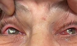 Kırlangıç Otu Suyu Göze Damlatılan Kadın Görme Kaybı Tehlikesi Yaşadı