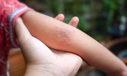 Menenjit Teşhisinde Cam Bardak Testi ve Hayati Uyarılar