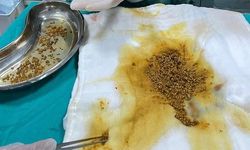 Safra kesesinden çıkarılan 2 bin 67 taş doktorları şaşırttı