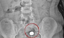 İstanbul'da 4 Yaşındaki Çocuk Pil Yuttu