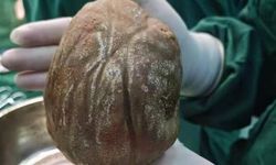 Mesanesinden 1,3 Kilogramlık Kitle Çıkan Adamın Hikayesi