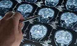 Yeni Araştırma Alzheimer Hastalığının Başlangıç Yaşını Gözler Önüne Serdi