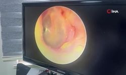 8 Yıllık Kulak Ağrısına Balon Östaki Tuboplasti ile Çözüm