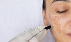 Yaz Aylarında Cilt Lekelerinin Koyulaşmasının Nedeni ve Dikkat Edilmesi Gerekenler