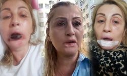 Antalya'da Estetik İşlem Sonrası Dudağında Doku Kaybı Yaşayan Kadının Hukuk Mücadelesi Sürüyor