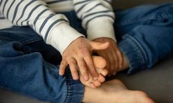 Çocuklarda El, Ayak ve Ağız Hastalığında Artış: Uzmanlardan Uyarılar
