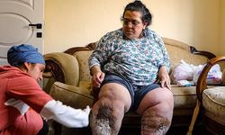 Lenfödem Hastalığıyla Mücadele Eden Anne Yardım Bekliyor