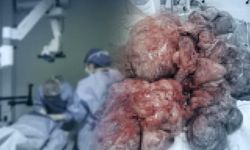 Rahminden 17 Kilogramlık Dev Miyom Çıkarıldı: Bilimsel Literatürde Bir İlk
