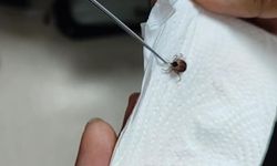 Çocuğun Kulağından Canlı Kene Başarıyla Çıkarıldı