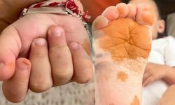 Çocuklarda El ve Ayaklarda Renk Değişimi: Karotenemi Nedir, Nasıl Anlaşılır?