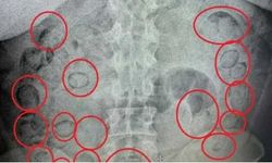 Midesinde yarım kilo uyuşturucu tespit edilen şüpheli tutuklandı