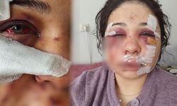 Polis Eşi Yüzünü Kesen Kadına Hapis Cezası Verildi