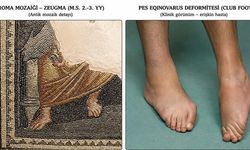 Zeugma Mozaik Müzesi'nde 1800 Yıllık Mozaikte Ekinus Tipi Ayak Deformitesi İddiası
