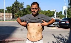 Adana'da Tüp Mide Ameliyatı Sonrası Sağlık Sorunları Yaşayan Genç Kadın Üç Kez Ameliyat Edildi