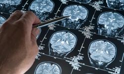 Alzheimer'da Beyin Damarlarını Koruyan Yeni Bulgular