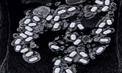 İzmir Havalimanında Şüpheli Yolcunun Midesinden 322 Gram Metamfetamin Çıkarıldı