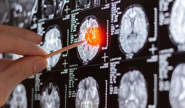 Beyin Tümörünün İlk Belirtilerine Dikkat
