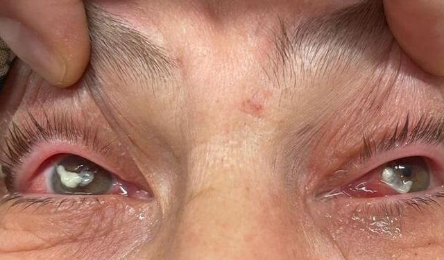 Kırlangıç Otu Suyu Göze Damlatılan Kadın Görme Kaybı Tehlikesi Yaşadı