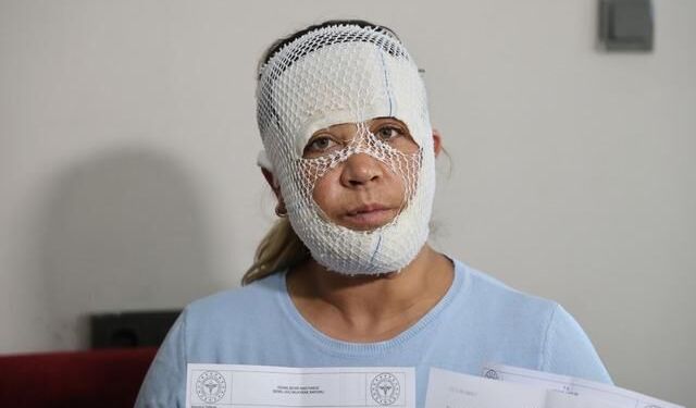 'Prenses Protokolü' Cilt Bakımı Yüzünde Yanıklara Sebep Oldu