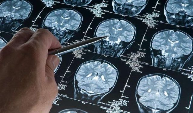 Alzheimer Hastalığında Erken Dönem: Biyobelirteçlerle Teşhis Mümkün Mü?