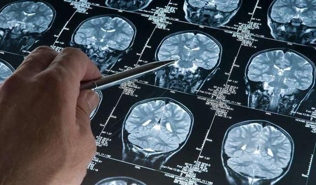 Yeni Araştırma Alzheimer Hastalığının Başlangıç Yaşını Gözler Önüne Serdi