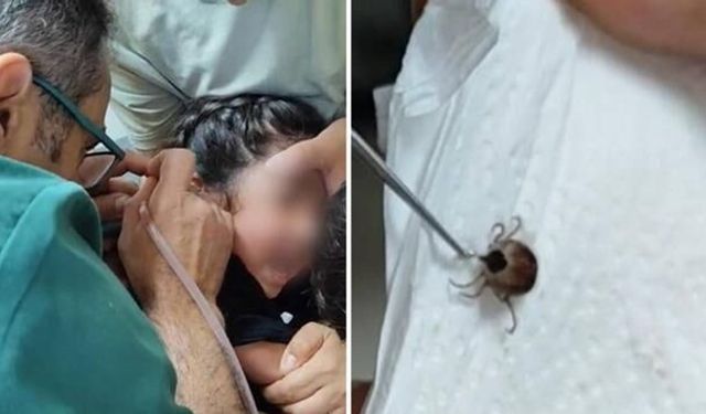 Eskişehir'de Kulak Ağrısı Şikayetiyle Gitti, Kulağından Canlı Kene Çıkarıldı