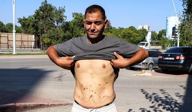 Adana'da Tüp Mide Ameliyatı Sonrası Sağlık Sorunları Yaşayan Genç Kadın Üç Kez Ameliyat Edildi