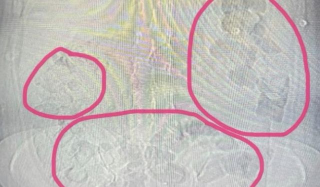 Sakarya'da midesinden uyuşturucu çıkan İranlı şüpheli tutuklandı