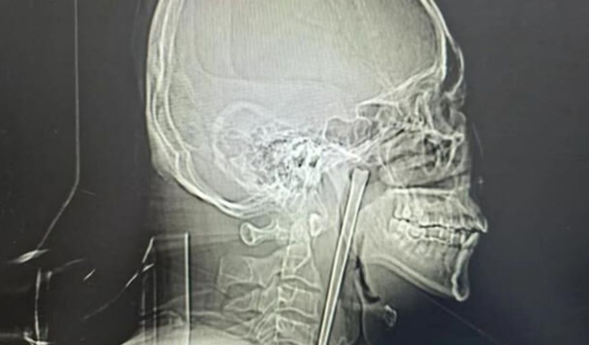 Boğazından 8 Yıl Boyunca Çıkarılamayan 12 Santimetrelik Metal Çubuk Ameliyatla Alındı