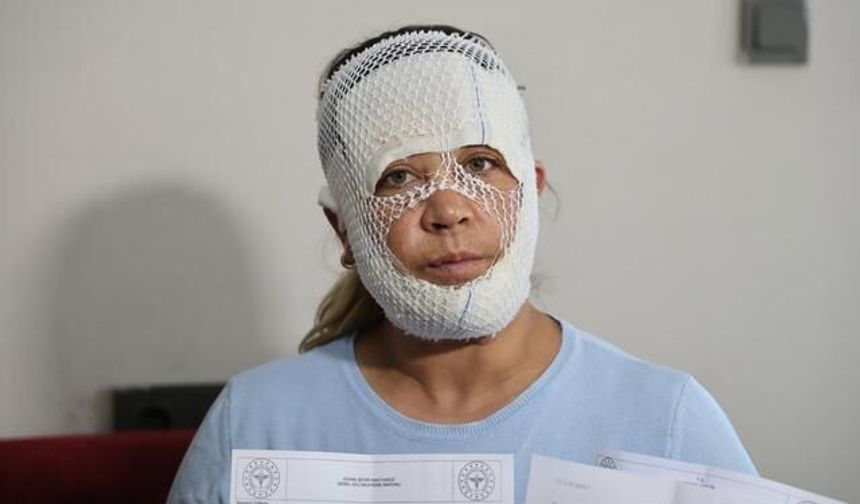 'Prenses Protokolü' Cilt Bakımı Yüzünde Yanıklara Sebep Oldu