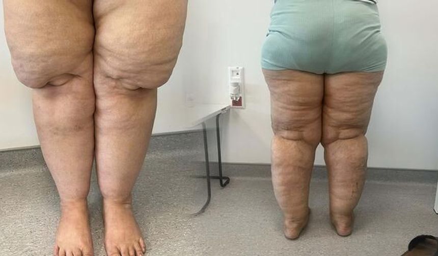 Lipödem Nedir? Kadınlarda Ağrılı Yağ Birikimi Sendromuna Dair Bilinmesi Gerekenler