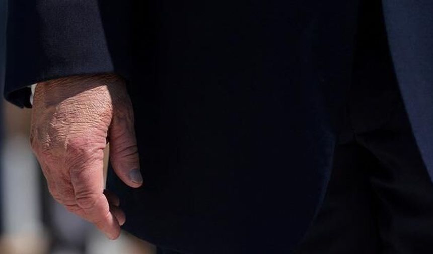 Donald Trump'ın Morlukları Makyajla Gizlenince Tartışma Yarattı