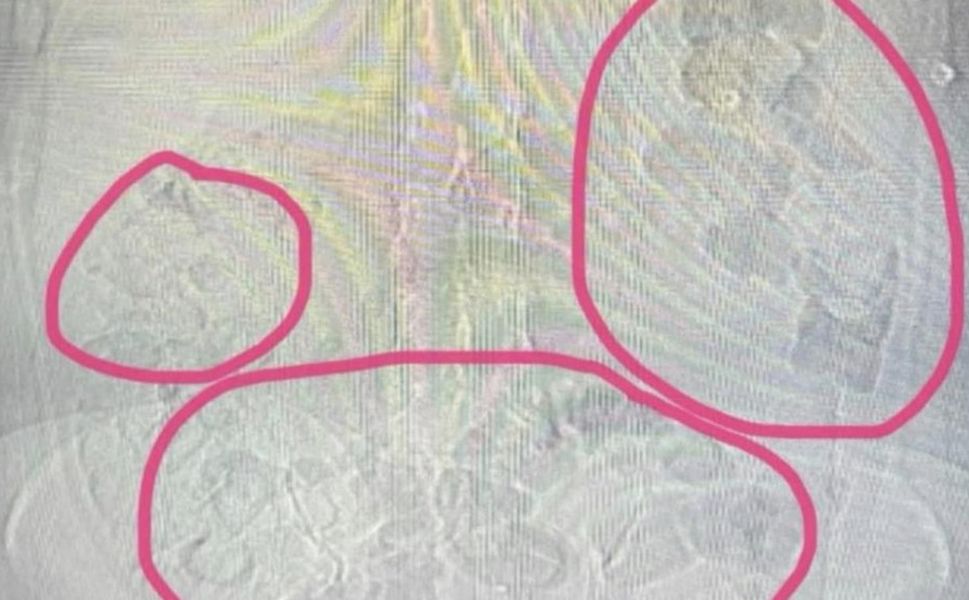 Sakarya'da midesinden uyuşturucu çıkan İranlı şüpheli tutuklandı