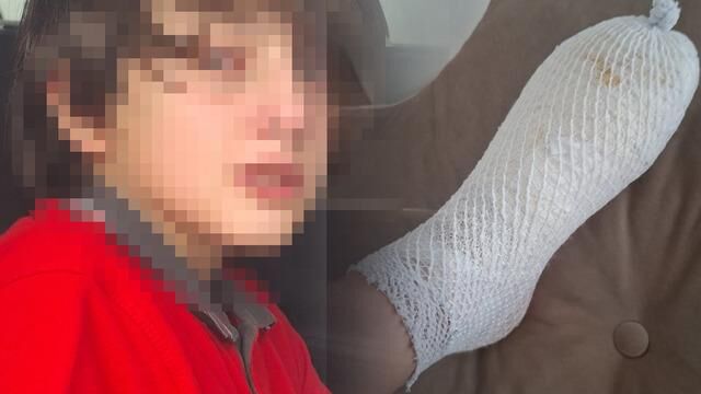 Ankara'da oyuncak patladı, 11 yaşındaki Furkan'ın ayağında 2'nci derece yanık oluştu
